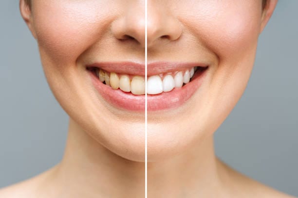 Aplicación de blanqueamiento dental profesional en consultorio — Consciencia Odontológica