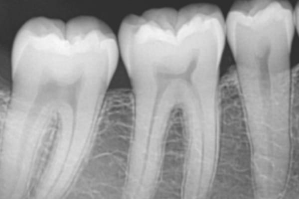 Radiografía periapical dental mostrando raíces — diagnóstico de endodoncia Consciencia Odontológica