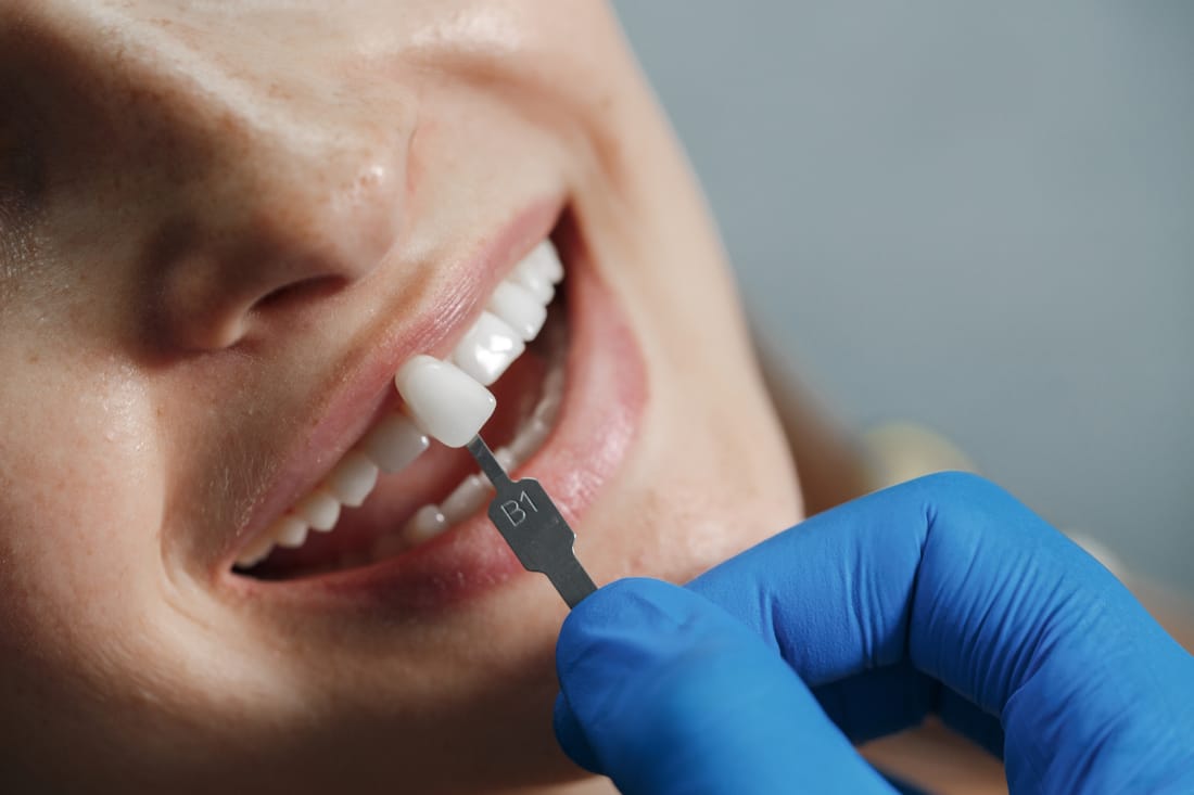Tratamiento de estética dental — preparación clínica para carillas y armonización Consciencia Odontológica