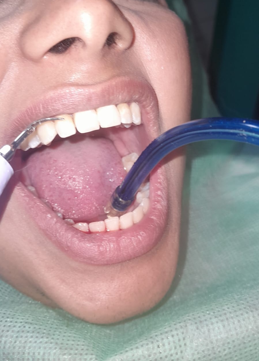 Procedimiento de periodoncia — limpieza y cuidado de encías, Consciencia Odontológica