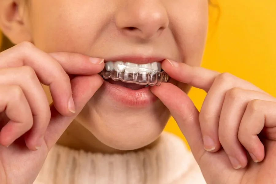 Alineador dental transparente siendo colocado sobre dentición — placa de descarga y tratamiento de bruxismo